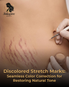 Discolored Stretch Marks: Seamless Color Correction for Restoring Natural Tone